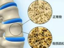 男性长期喝可乐的危害：精子减少、牙齿损伤、体重增加与骨质疏松风险