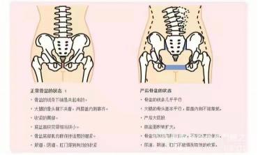 骨盆修复有必要吗？产后恢复的必修课！