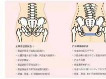 骨盆修复有必要吗？产后恢复的必修课！